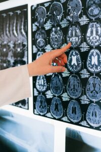 Mão de um profissional de saúde apontando para uma ressonância magnética do cérebro, representando transtornos mentais e neurologia.