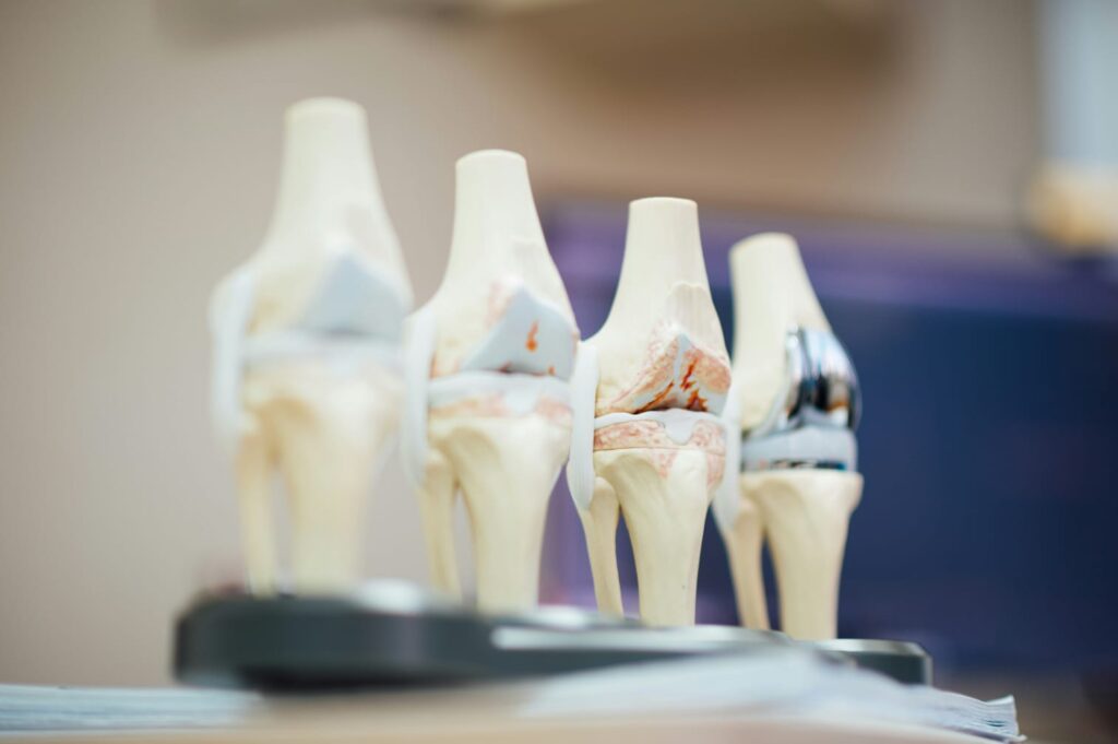 Modelos anatômicos de joelhos com sinais de desgaste e dor articular.