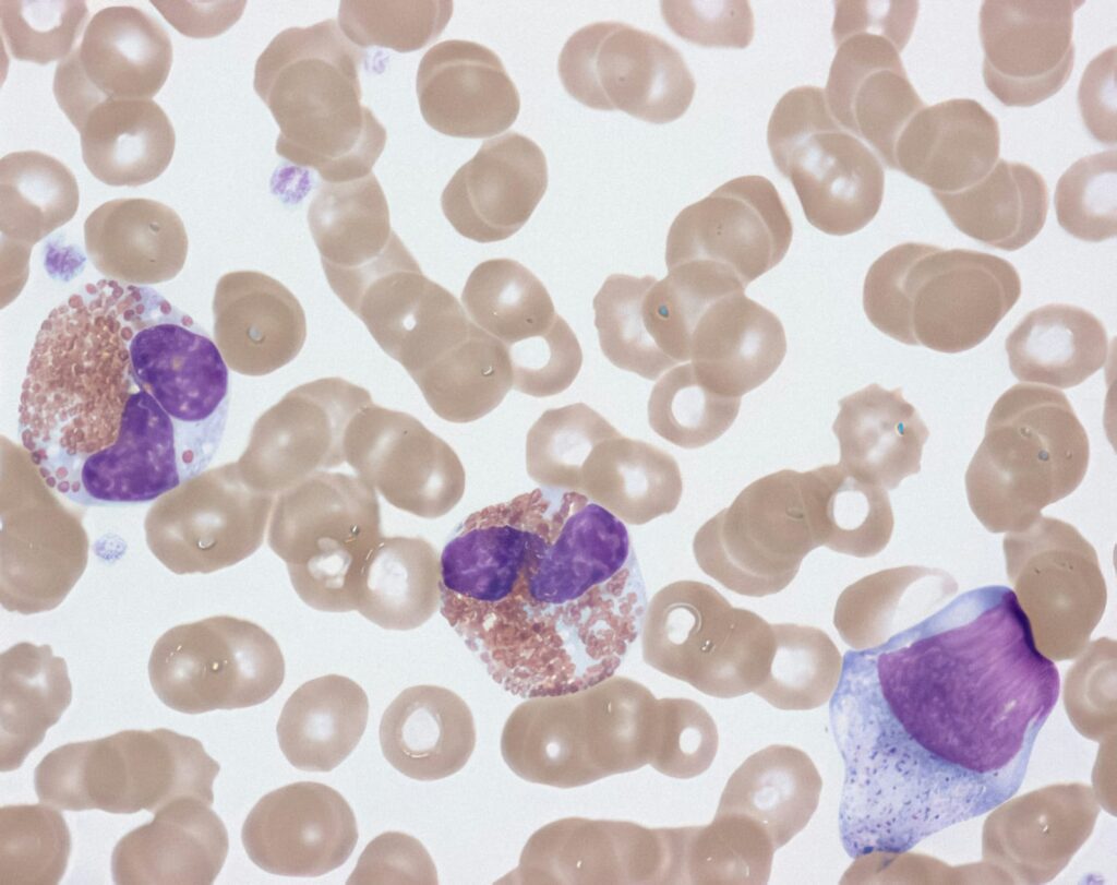 Exame de sangue ao microscópio mostrando células sanguíneas e alterações associadas à inflamação.