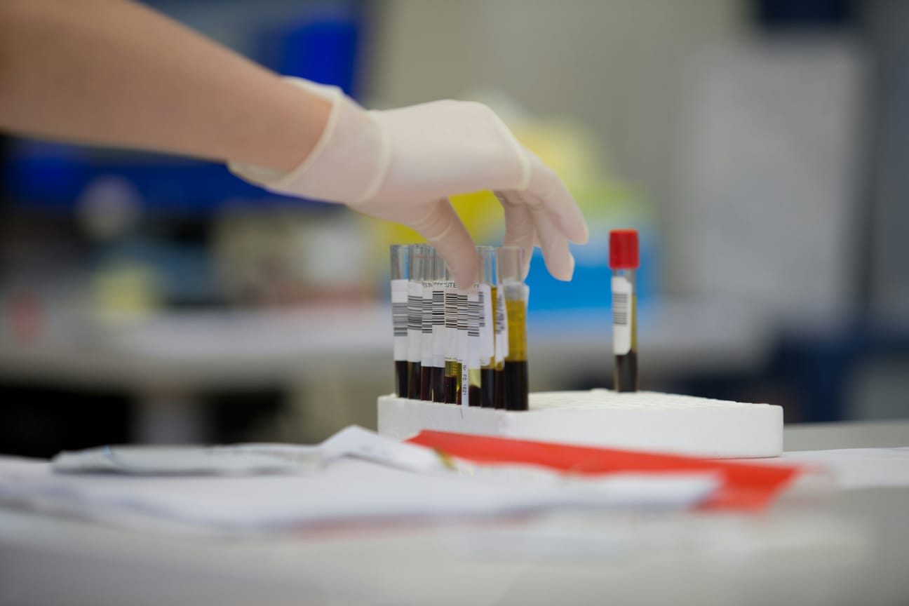 Exames de sangue são a principal forma de diagnostico para a hipercolesterolemia familiar.
