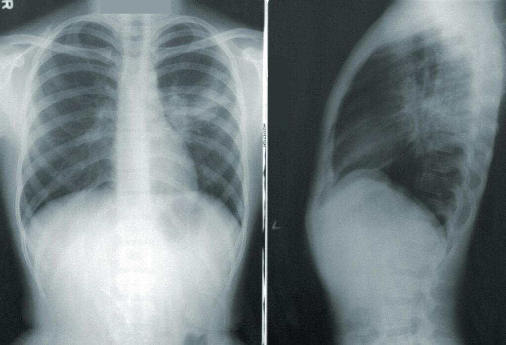 Radiografia de tórax mostrando coração e pulmões com alterações compatíveis com hipertensão pulmonar.