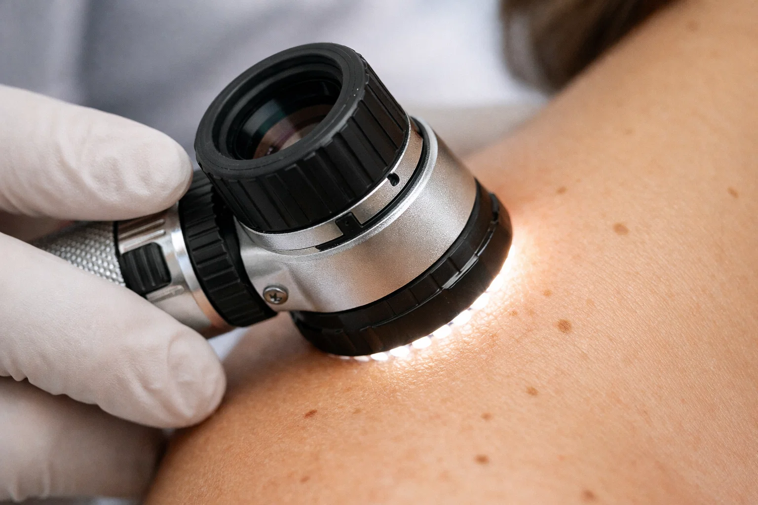 Dermatologista examinando pinta na pele com dermatoscópio durante avaliação de câncer de pele.